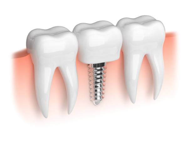 dental implants near me mill hill north london